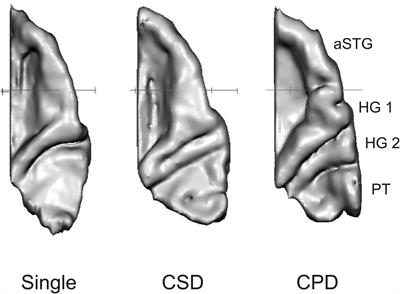 “When Music Speaks”: Auditory Cortex Morphology as a Neuroanatomical Marker of Language Aptitude and Musicality